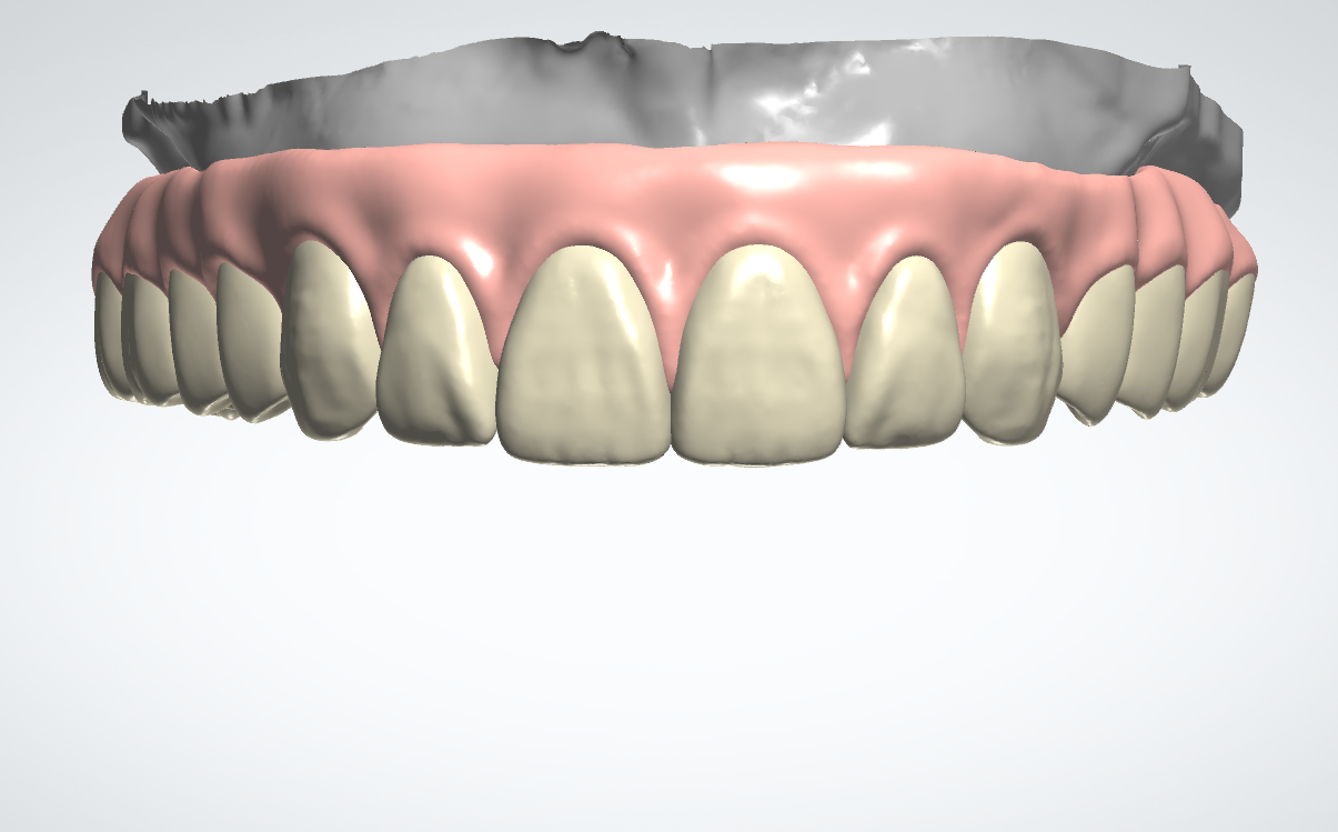 Gingiva Crown Design